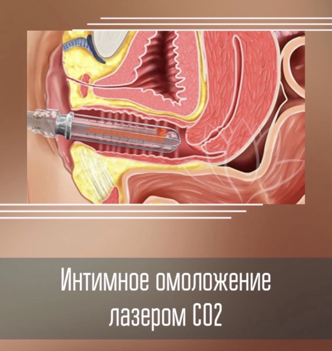 Лазерный фототермолиз влагалища