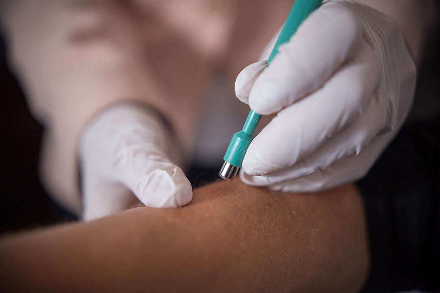 Панч биопсия кожи